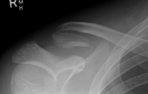 Lateral Clavicle Fracture